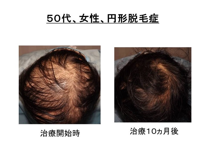 円形脱毛症　病院